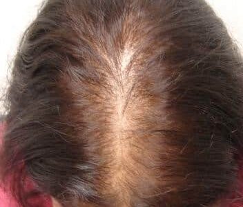 الصلع الوراثي